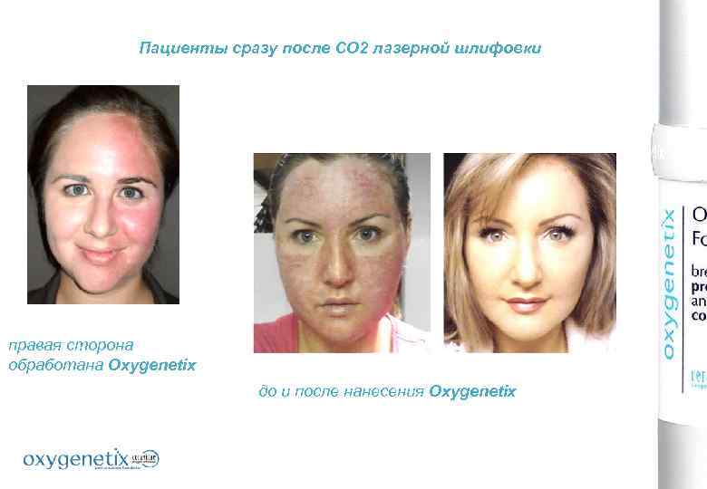Пациенты сразу после СО 2 лазерной шлифовки правая сторона обработана Oxygenetix до и после