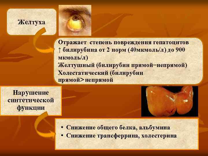 Желтуха Отражает степень повреждения гепатоцитов ↑ билирубина от 2 норм (40 мкмоль/л) до 900