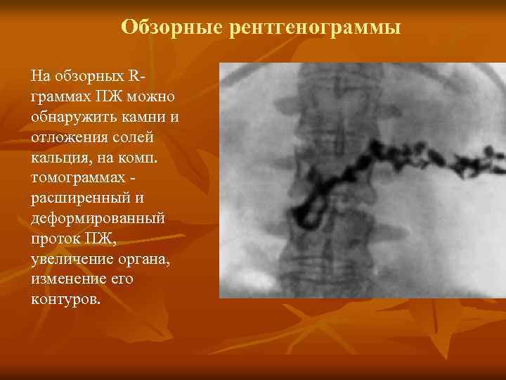 Обзорные рентгенограммы На обзорных Rграммах ПЖ можно обнаружить камни и отложения солей кальция, на