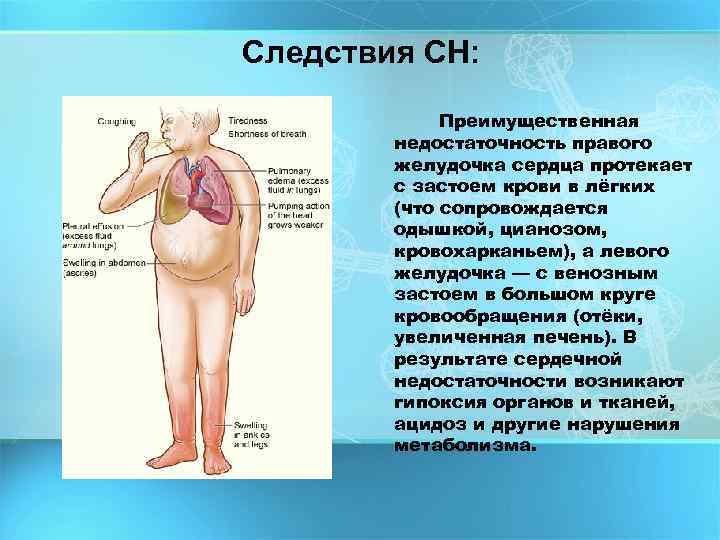 Следствия СН: Преимущественная недостаточность правого желудочка сердца протекает с застоем крови в лёгких (что