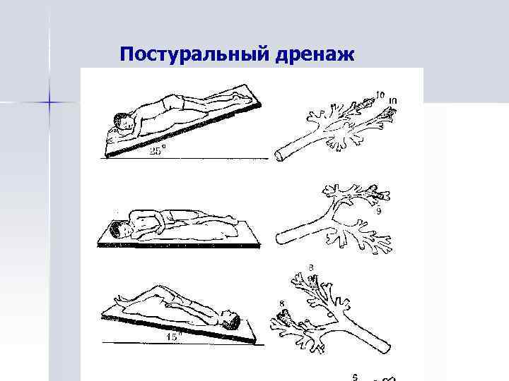 Основные направления в лечении осложненной пневмонии у детей Постуральный дренаж 