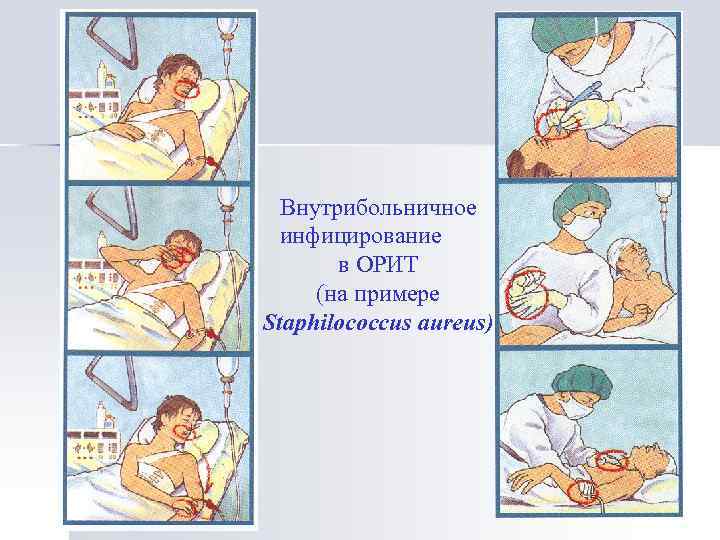 Внутрибольничное инфицирование в ОРИТ (на примере Staphilococcus aureus) 