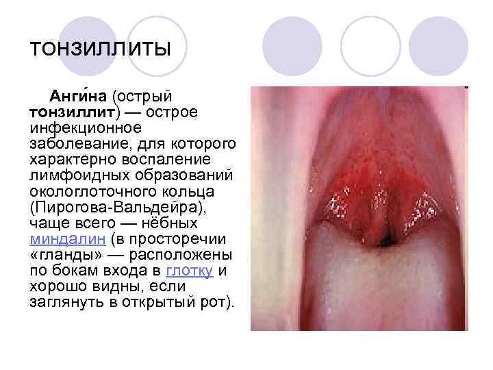 тонзиллиты Анги на (острый тонзиллит) — острое инфекционное заболевание, для которого характерно воспаление лимфоидных
