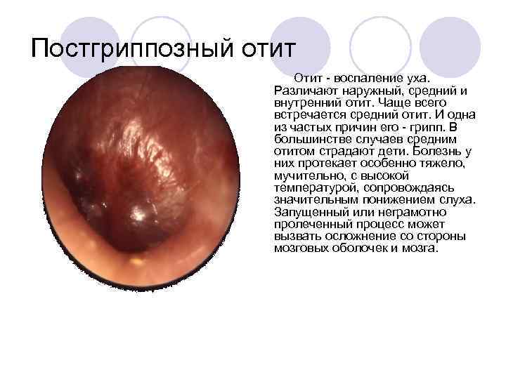 Постгриппозный отит Отит воспаление уха. Различают наружный, средний и внутренний отит. Чаще всего встречается