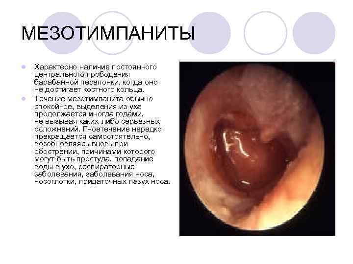 МЕЗОТИМПАНИТЫ l l Характерно наличие постоянного центрального прободения барабанной перепонки, когда оно не достигает