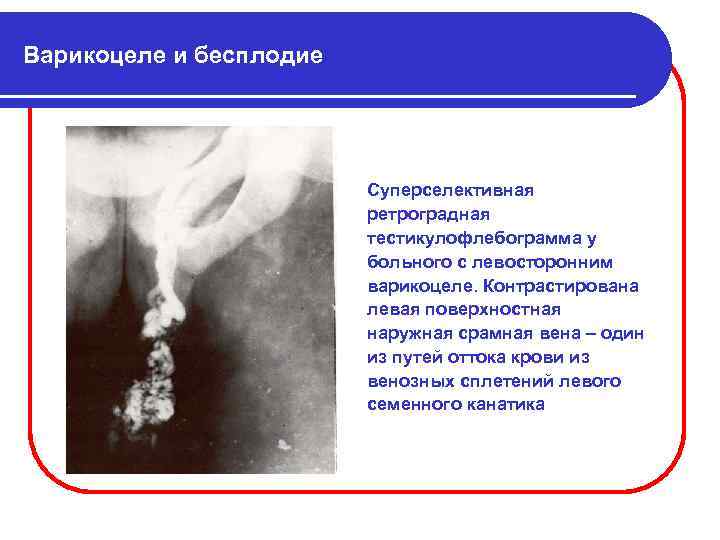 Варикоцеле и бесплодие Суперселективная ретроградная тестикулофлебограмма у больного с левосторонним варикоцеле. Контрастирована левая поверхностная