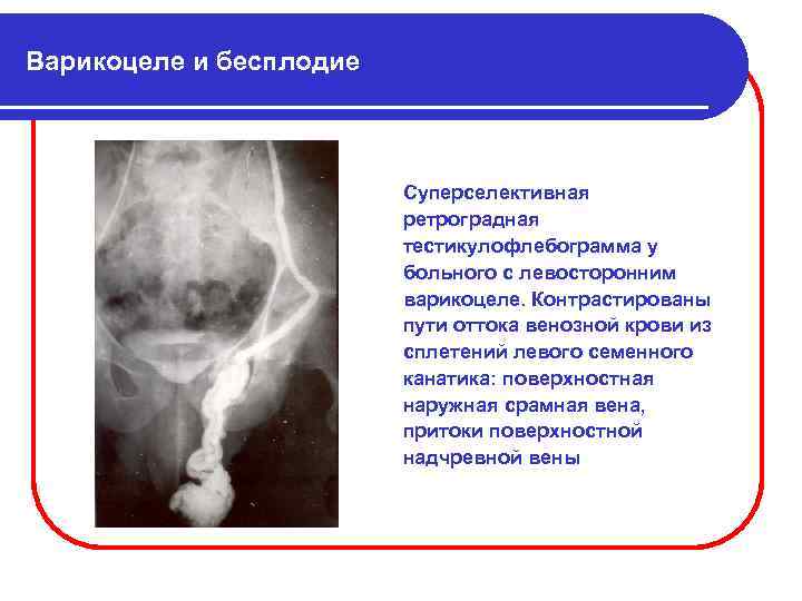 Варикоцеле у мужчин