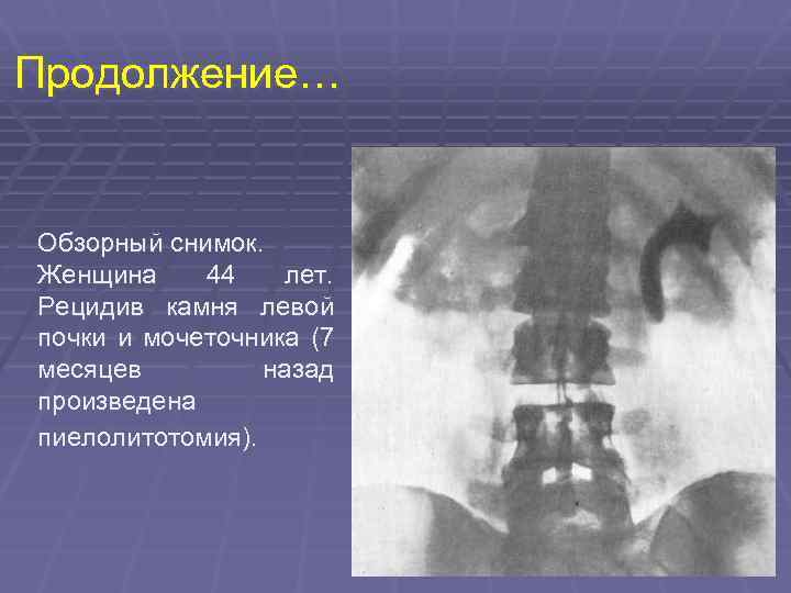 Продолжение… Обзорный снимок. Женщина 44 лет. Рецидив камня левой почки и мочеточника (7 месяцев