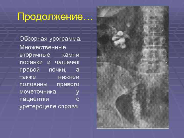 Конкременты лоханки