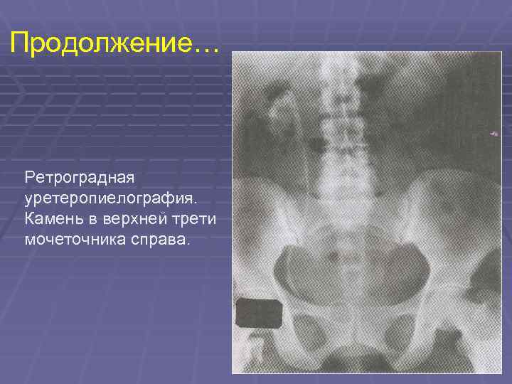 Верхняя треть мочеточника. Камень верхней трети левого мочеточника. Камень нижней трети правого мочеточника. Ретроградная уретеропиелография камень. Ретроградная пиелография почек.