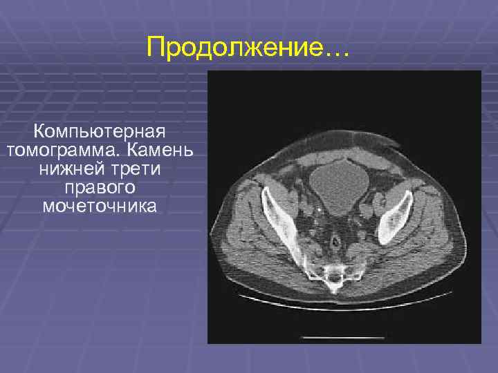 Продолжение… Компьютерная томограмма. Камень нижней трети правого мочеточника 