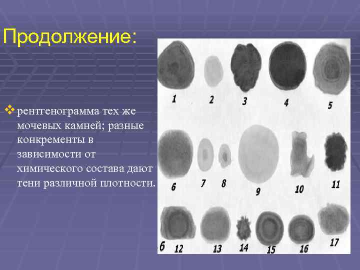 Продолжение: v рентгенограмма тех же мочевых камней; разные конкременты в зависимости от химического состава