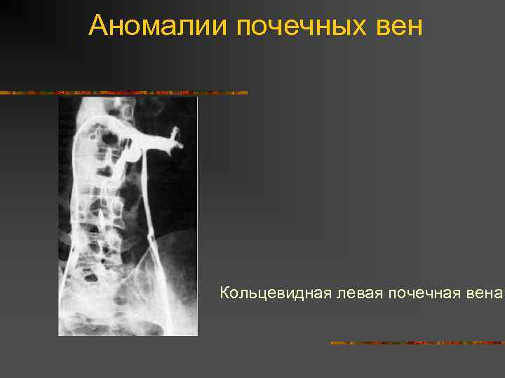 Аномалии почечных вен Кольцевидная левая почечная вена 
