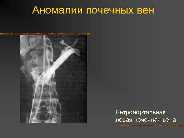 Аномалии почечных вен Ретроаортальная левая почечная вена 