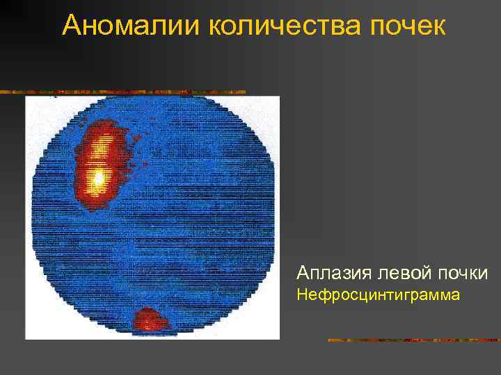 Аномалии количества почек Аплазия левой почки Нефросцинтиграмма 
