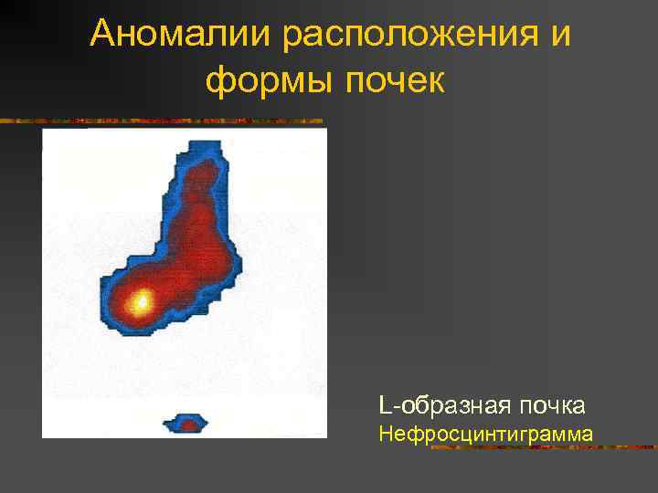 Аномалии расположения и формы почек L-образная почка Нефросцинтиграмма 