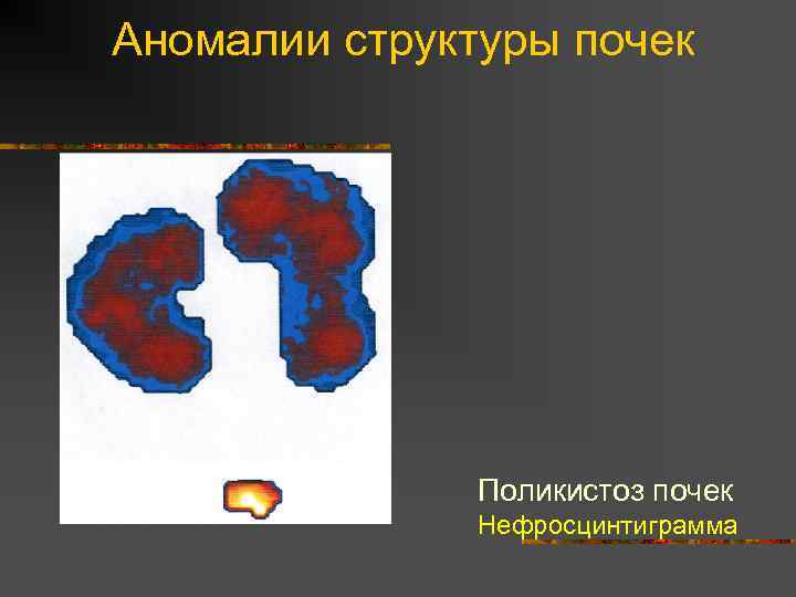Аномалии структуры почек Поликистоз почек Нефросцинтиграмма 