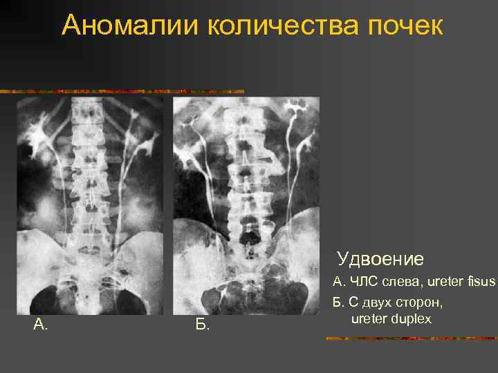 Удвоение левой почки фото