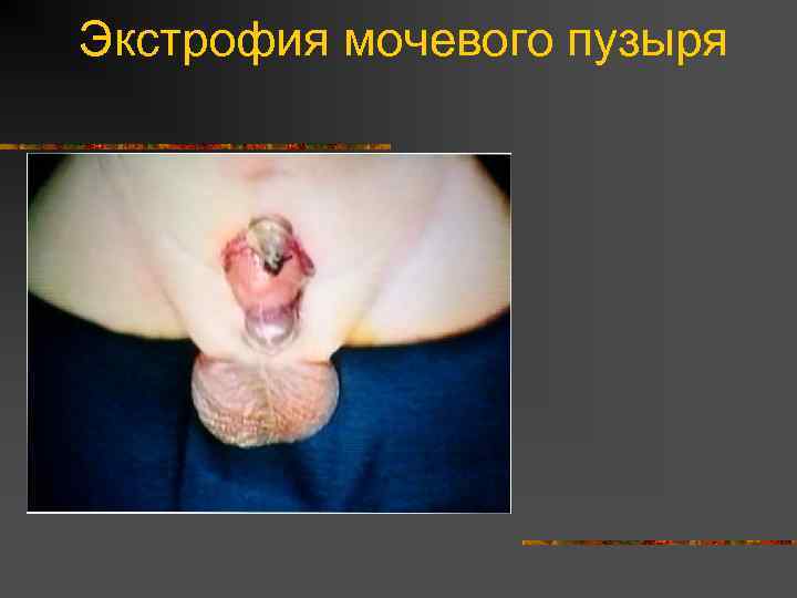 Экстрофия мочевого пузыря 