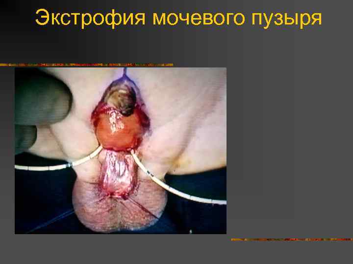 Экстрофия мочевого пузыря 