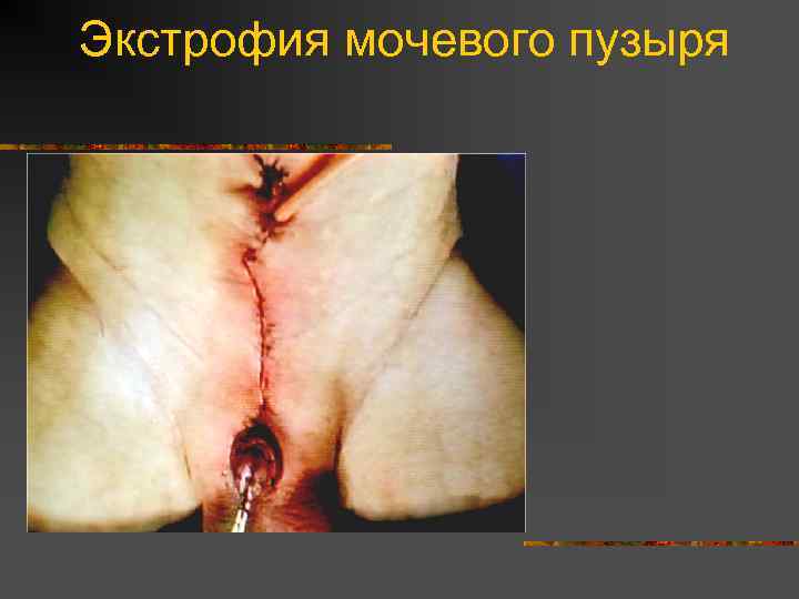 Экстрофия мочевого пузыря 