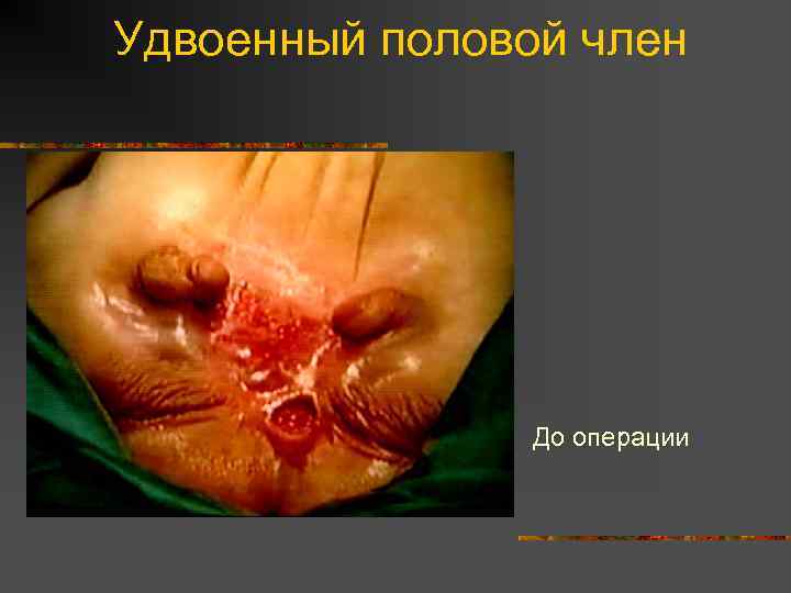 Удвоенный половой член До операции 