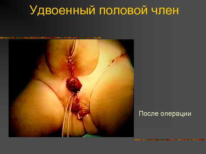 Удвоенный половой член После операции 