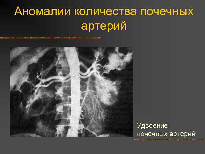 Фото удвоенной почки