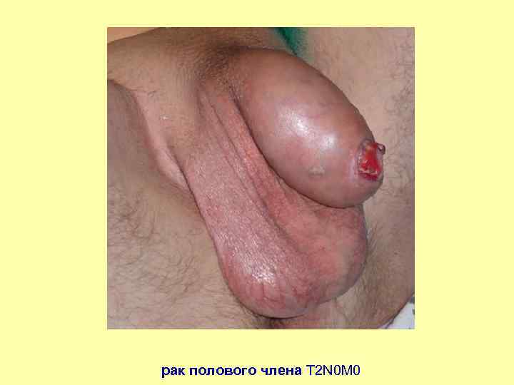 рак полового члена Т 2 N 0 M 0 
