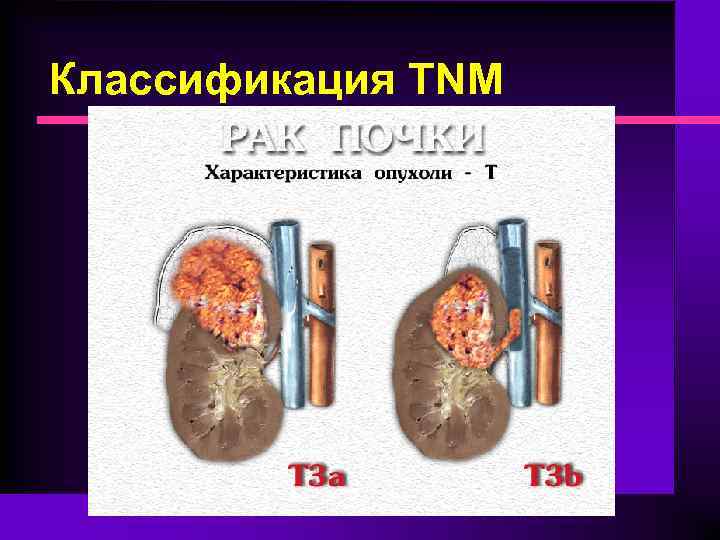 Классификация TNM 