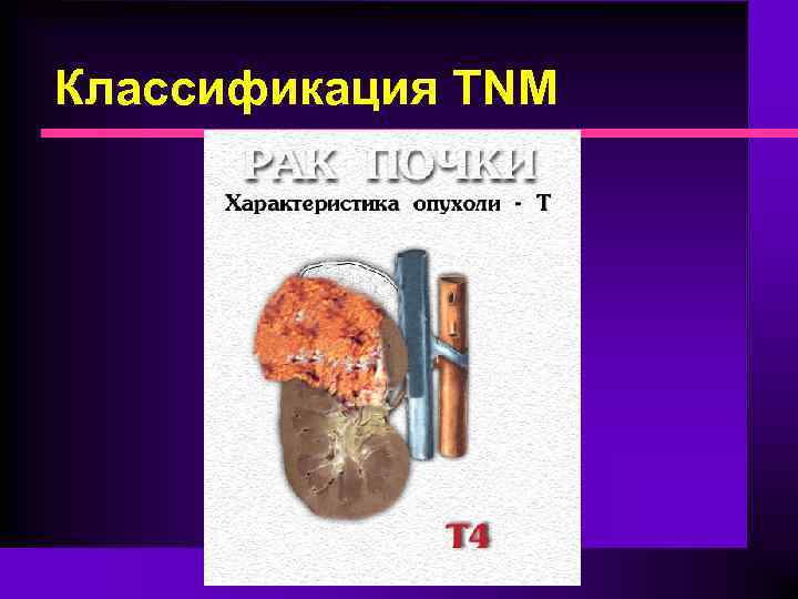 Классификация TNM 