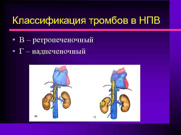 Классификация тромбов в НПВ • В – ретропеченочный • Г – надпеченочный 