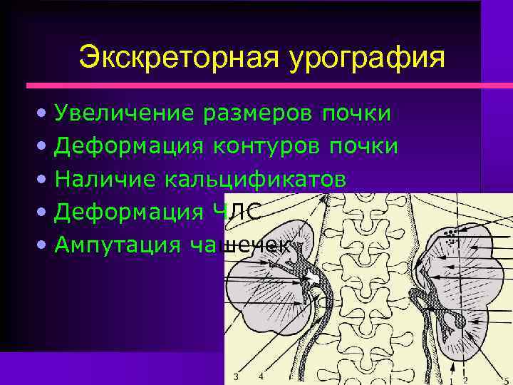 Экскреторная урография • Увеличение размеров почки • Деформация контуров почки • Наличие кальцификатов •