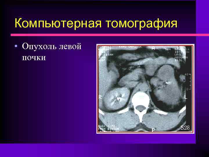 Компьютерная томография • Опухоль левой почки 