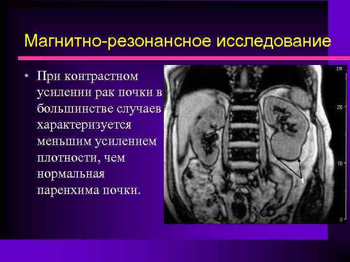 Магнитно-резонансное исследование • При контрастном усилении рак почки в большинстве случаев характеризуется меньшим усилением