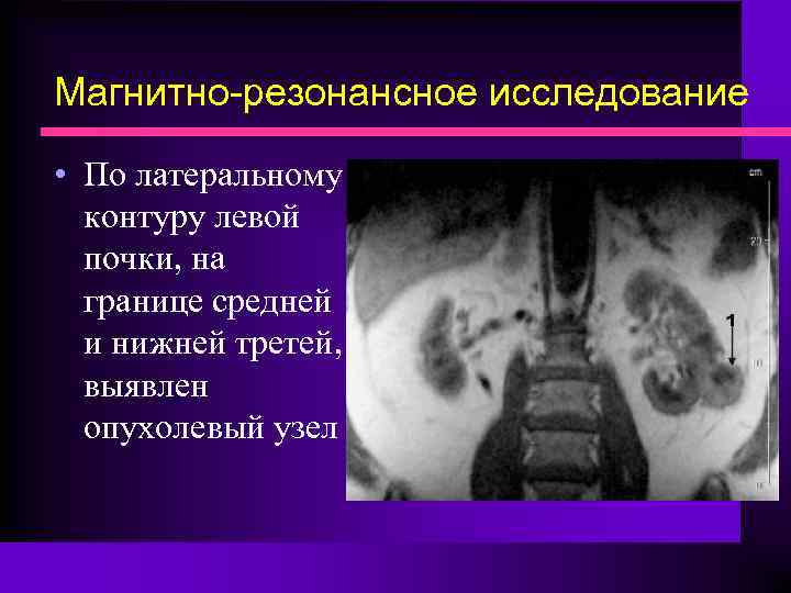 Магнитно-резонансное исследование • По латеральному контуру левой почки, на границе средней и нижней третей,