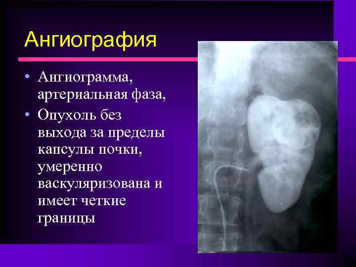 Ангиография • Ангиограмма, артериальная фаза, • Опухоль без выхода за пределы капсулы почки, умеренно