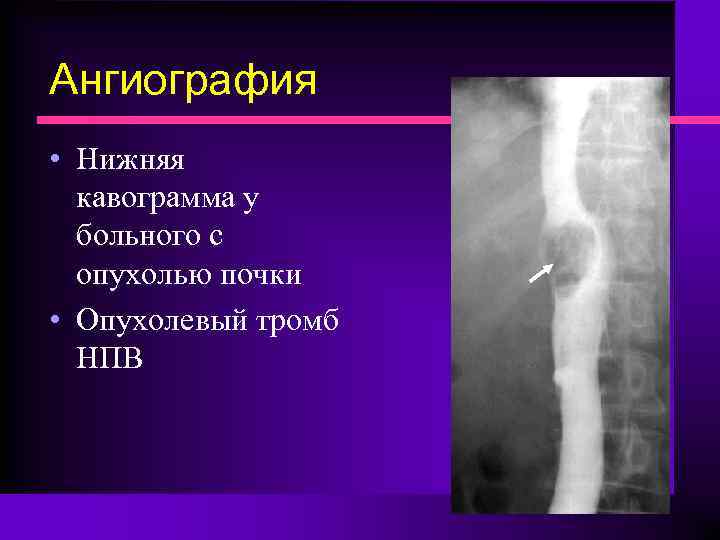 Ангиография • Нижняя кавограмма у больного с опухолью почки • Опухолевый тромб НПВ 