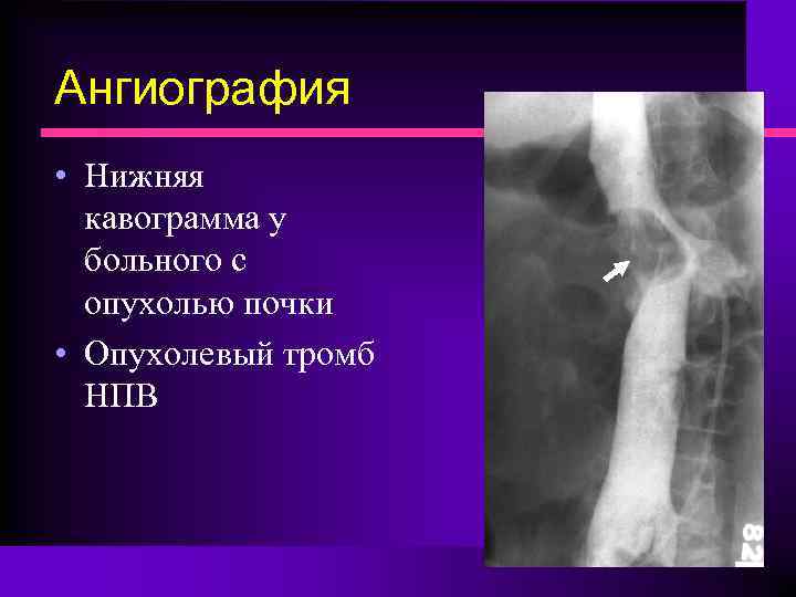 Ангиография • Нижняя кавограмма у больного с опухолью почки • Опухолевый тромб НПВ 