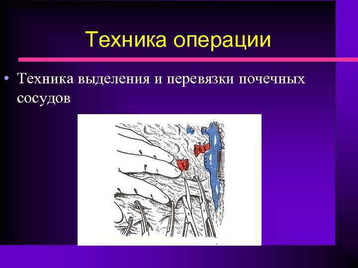 Техника операции • Техника выделения и перевязки почечных сосудов 