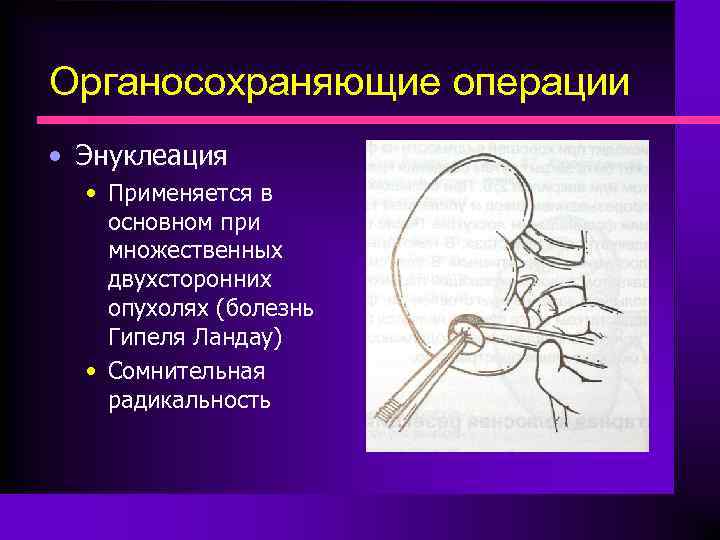 Органосохраняющие операции • Энуклеация • Применяется в основном при множественных двухсторонних опухолях (болезнь Гипеля