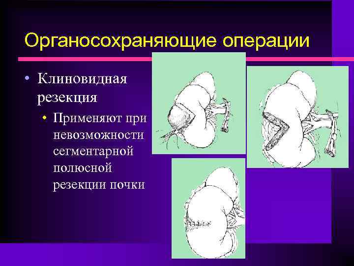 Органосохраняющие операции • Клиновидная резекция • Применяют при невозможности сегментарной полюсной резекции почки 