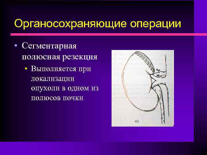 Органосохраняющие операции • Сегментарная полюсная резекция • Выполняется при локализации опухоли в одном из