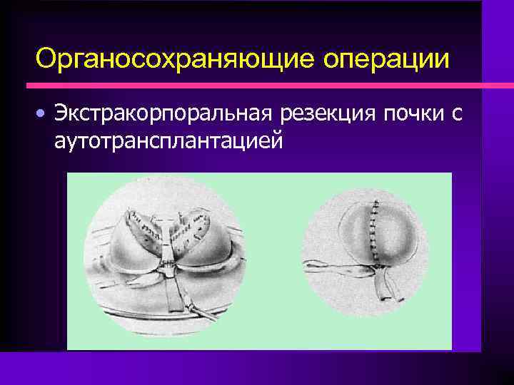 Органосохраняющие операции • Экстракорпоральная резекция почки с аутотрансплантацией 