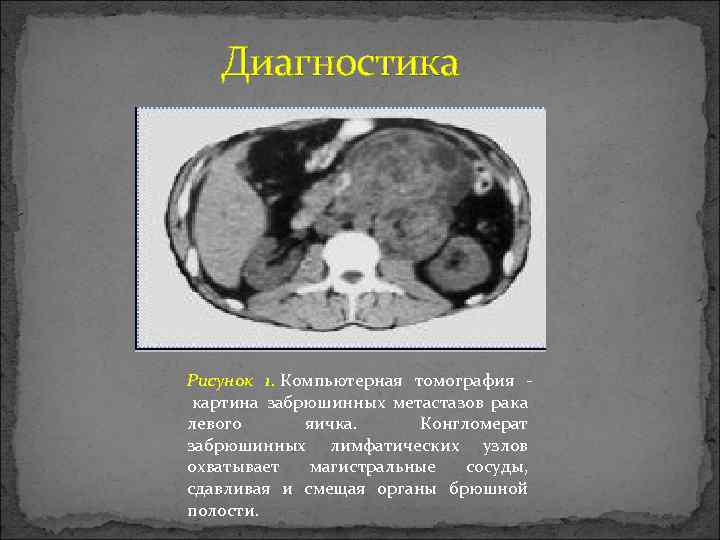  Диагностика Рисунок 1. Компьютерная томография картина забрюшинных метастазов рака левого яичка. Конгломерат забрюшинных