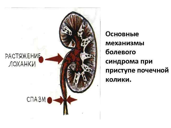 Основные механизмы болевого синдрома приступе почечной колики. 
