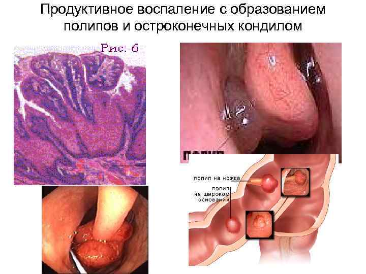 Продуктивное воспаление с образованием полипов и остроконечных кондилом 