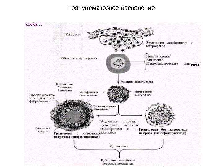 Гранулематозное воспаление 