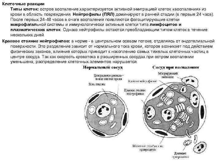 Клеточные реакции Типы клеток: острое воспаление характеризуется активной эмиграцией клеток «воспаления» из крови в