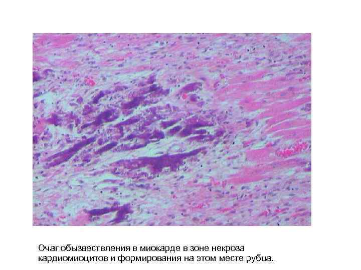 Очаг обызвествления в миокарде в зоне некроза кардиомиоцитов и формирования на этом месте рубца.